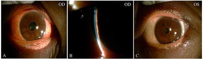 Choroidal Metastatic Carcinoma Accompanied With Sjögren Syndrome Initially Presenting as Acute Glaucoma With Angle Closure: Case Report